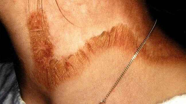 Brown, scaly, collar-shaped band of darkened skin encircling the base of the neck, known as Casal&rsquo;s necklace