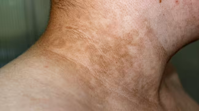 Velvety gray-brown thickened skin on the side and back of a neck, the classic look of acanthosis nigricans