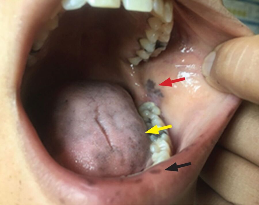 Inside of an open mouth with dark brown pigmented patches on the inner cheek, tongue, and gum line
