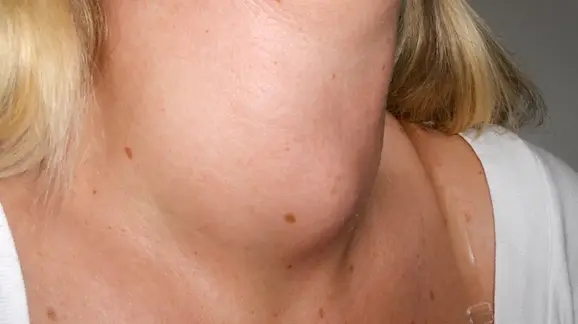 Front of a neck showing a smooth swelling below the Adam&rsquo;s apple from an enlarged thyroid gland