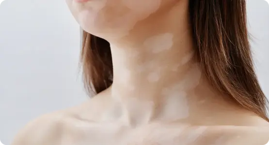 Skin with sharply bordered milk-white patches where pigment has been lost, characteristic of vitiligo