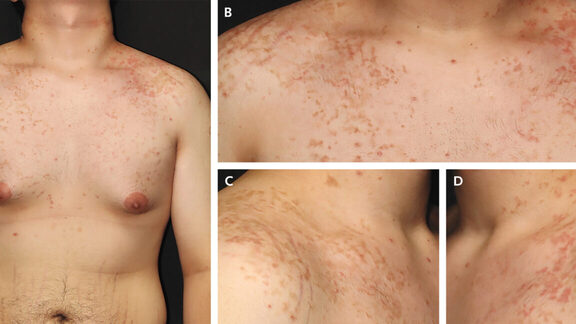 Reticulated net-like reddish-brown rash spread across the chest, neck, and upper back